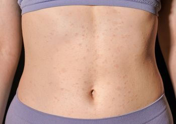 Wysypka na brzuchu o podłożu alergicznym przybiera postać pokrzywki lub zaczerwienienia, którym towarzyszą drobne grudki, przesuszenie skóry oraz uporczywy świąd. Fot. Adobe Stock.