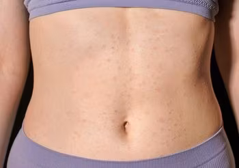 Wysypka na brzuchu o podłożu alergicznym przybiera postać pokrzywki lub zaczerwienienia, którym towarzyszą drobne grudki, przesuszenie skóry oraz uporczywy świąd. Fot. Adobe Stock.