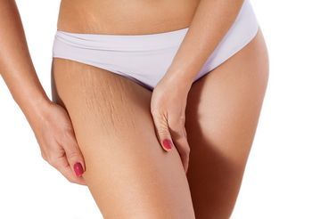 Zbliżenie na skórę z widocznymi rozstępami 